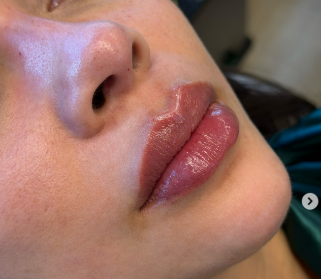 Botox