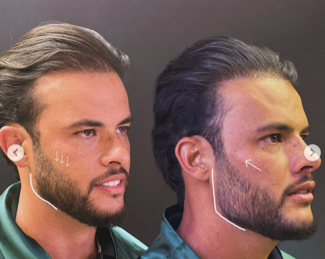 Preenchimento Mandibular & Facial